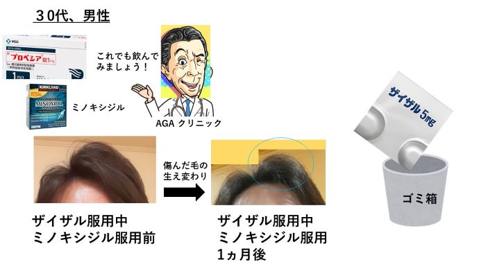 円形脱毛症　病院